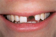 Dental Implant For Missing Front Tooth before 504342