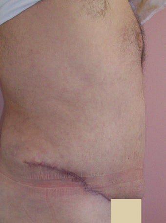 Tummy Tuck before and after after 149754
