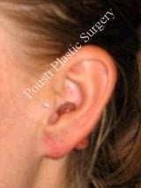 Earlobe Repair Surgery after 612304