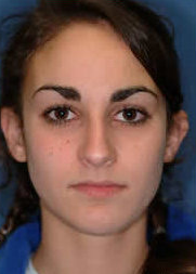 Rhinoplasty before 317175