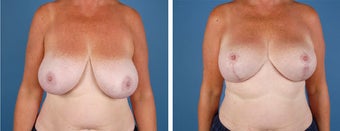 Breast Lift before 355777