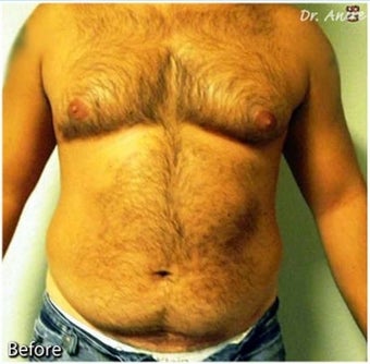 Male Liposuction of Abdomen and flanks before 277008