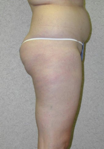 Lower Body Lift 410338
