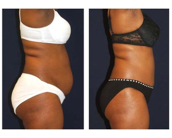 Tummy Tuck / Abdominoplasty before 55004