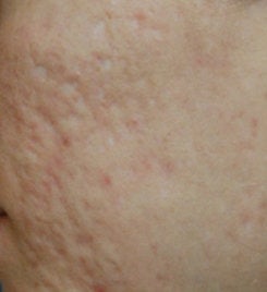 Acne Scar Vitalizer Treatment before 562078