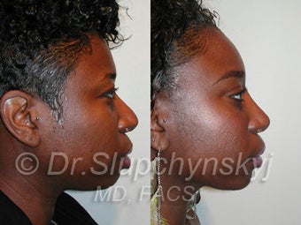 African American Rhinoplasty 374061