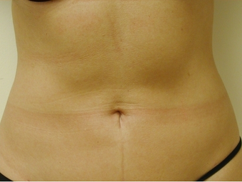 SmartLipo Abdomen 141873