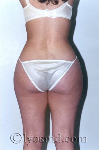 Liposuction before 225378