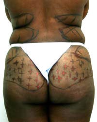 Liposuction and Buttock augmentation before 577820