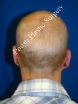 Ear Surgery (Otoplasty) after 616669