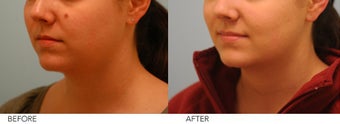 Mole Removal after 267692