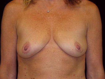 Breast augmentation before 293954