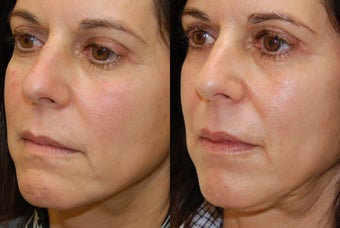Lip Augmentation with Silikon-1000 before 407825