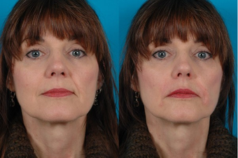 Restylane before 574583