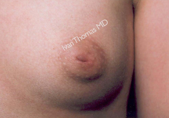 Nipple Surgery before 243247