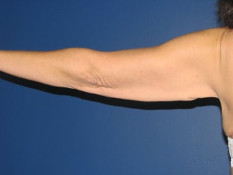 Brachioplasty 575816