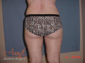 Vaser Lipo - Outer Thighs after 376428