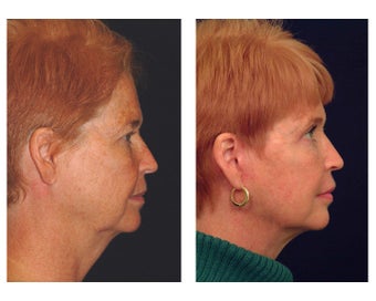 Lower Face & Neck Lift after 349225