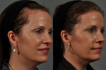 Hair Transplant Before & After before 575259