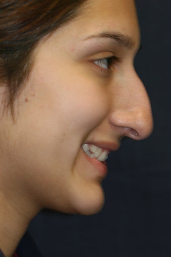 Rhinoplasty and Septoplasty 527291