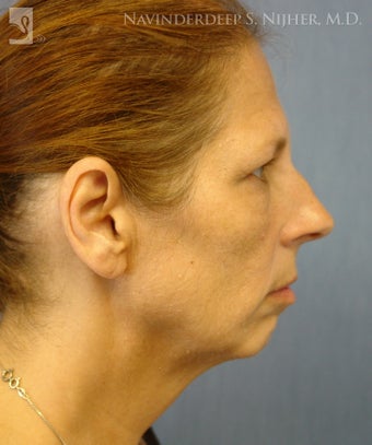 Chin Implant before 502574