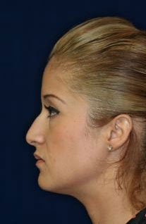 Rhinoplasty and Septoplasty before 223643