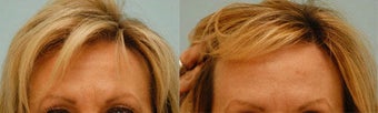 Botox before 138512