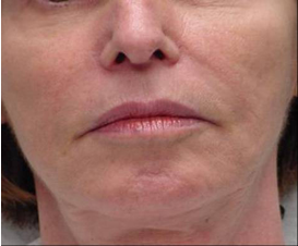 Exilis after 424074