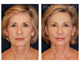Lower Face and Neck Lift 355087