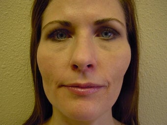 Microlaser Peels after 531108