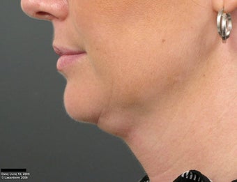 Ulthera Laser Skin Tightening before 346277