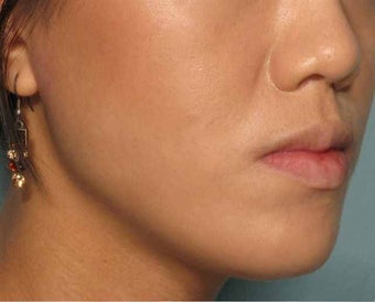 Radiesse in the chin after 343304
