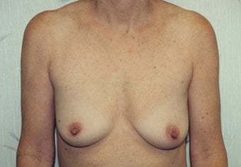 Breast Augmentation before 266793
