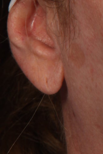 Juvederm Ultra Plus to Earlobes before 308311
