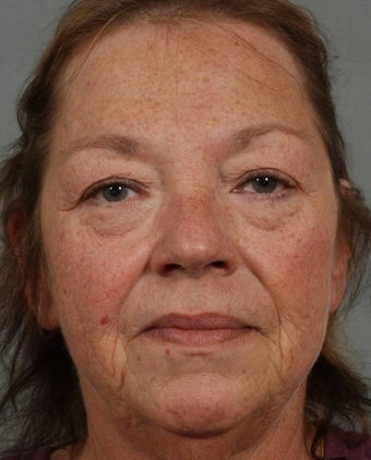 Juvederm, Radiesse, Botox before 355099