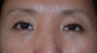 Asian Blepharoplasty to remove eye bags after 80806