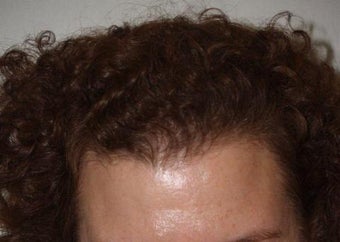 Hair Transplant after 224846