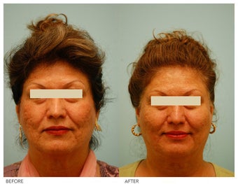 Acne Scarring Correction before 136803