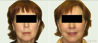 Facelift and Necklift before 273683