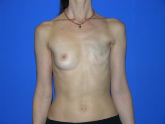 Breast Reconstruction before 482769