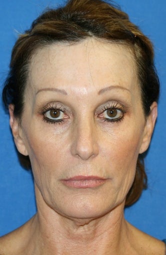 Facelift with Extended Necklift and Upper Blepharoplasty before 641627