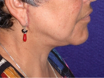 Necklift 208453