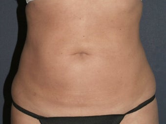 Liposculpture 486595