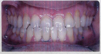 Anterior Crossbite before 353446