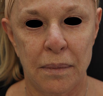 TCA Full-Face Chemical Peel before 182429