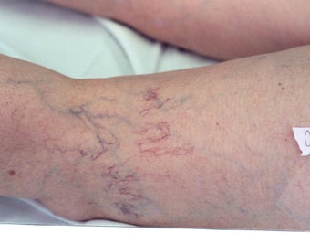 Sclerotherapy before 297055