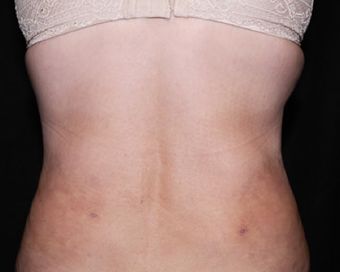 Laser Liposuction after 362280