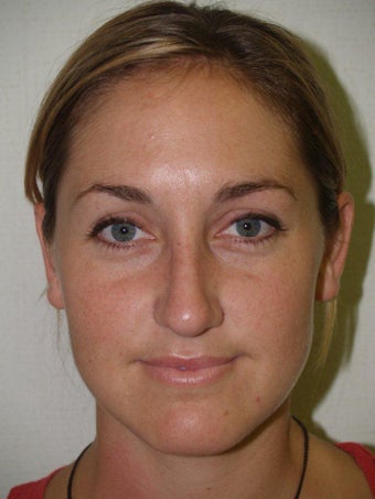Rhinoplasty after 208155