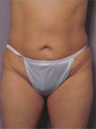 Abdominoplasty before 428196