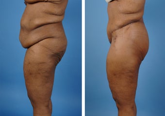 Lower Body Lift with Laser Liposuction to the Hips and Thighs after 335995